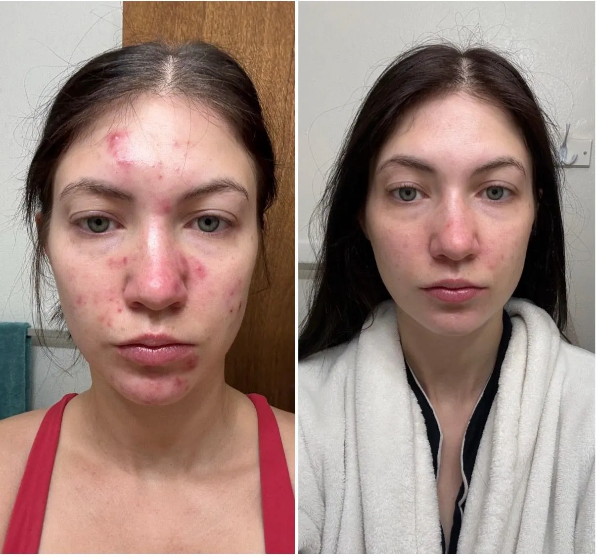 Gut-driven acne cleared, before and after